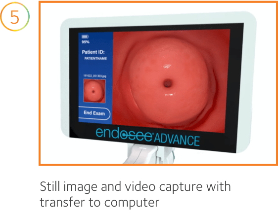 The image monitor of the Endosee Advance, on the screen is a simulated endometrial diagnostic scan with patient information and battery life. Text on the image reads: 5. Still image and video capture with transfer to computer