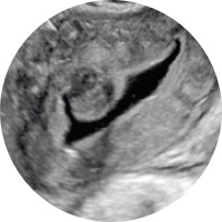 Saline Infused Sonohysterography