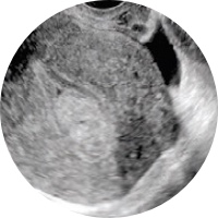 Transvaginal Ultrasound